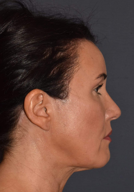 After Image: Facial Rejuvenation – Brow Lift with Chin Implant and Revision Neck Lift - other