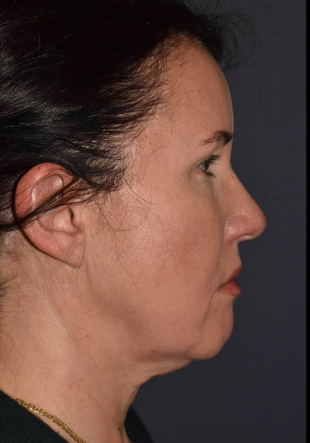 Facial Rejuvenation – Brow Lift with Chin Implant and Revision Neck Lift