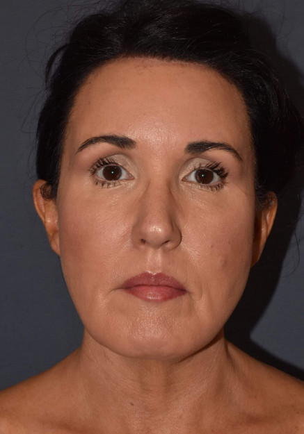 After Image: Facial Rejuvenation – Brow Lift with Chin Implant and Revision Neck Lift - front