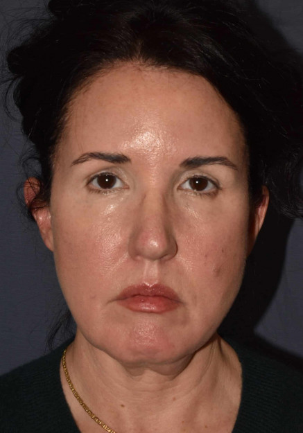 Before Image: Facial Rejuvenation – Brow Lift with Chin Implant and Revision Neck Lift - front
