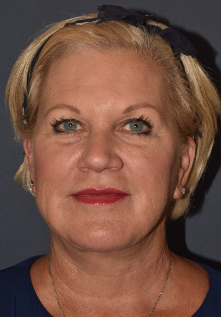 After Image: Facial Rejuventation – Face Lift with Chin Implant - front
