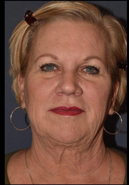 Before Image: Facial Rejuventation – Face Lift with Chin Implant - front