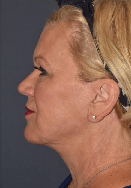 Facial Rejuventation – Face Lift with Chin Implant