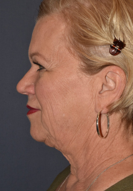 Before Image: Facial Rejuventation – Face Lift with Chin Implant - other