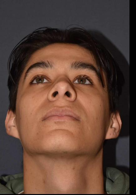Rhinoplasty – Open
