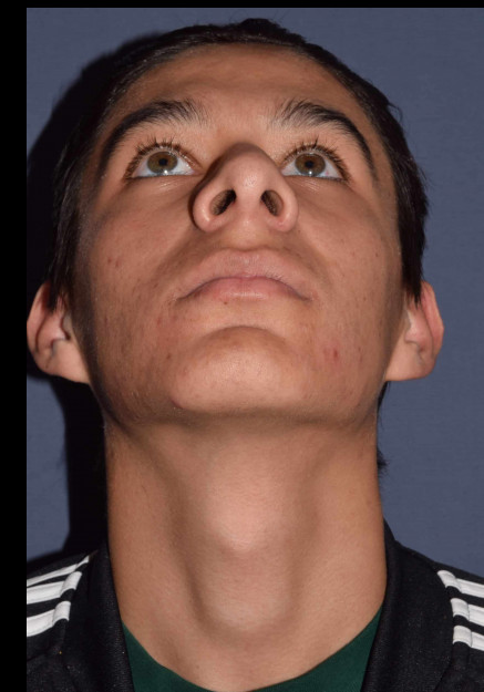 Rhinoplasty – Open