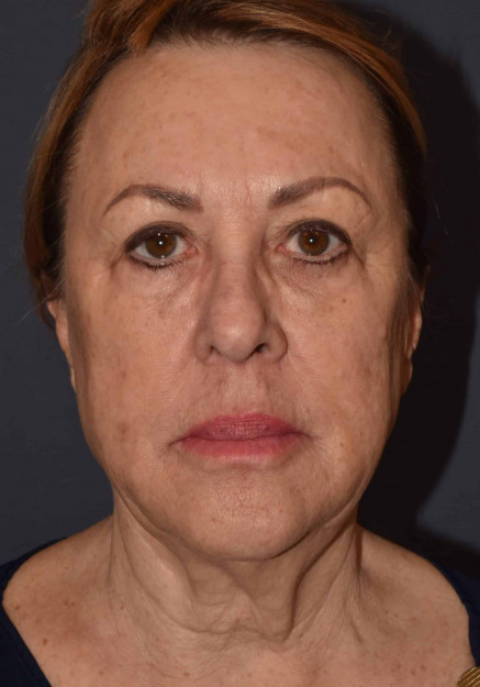 Facial Rejuvenation – Facelift