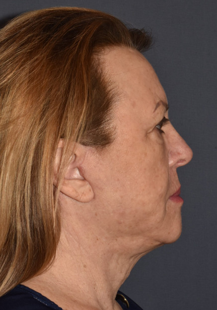 Facial Rejuvenation – Facelift