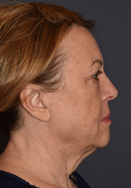 Facial Rejuvenation – Facelift