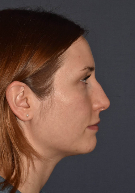 Before Image: Rhinoplasty – Closed - other