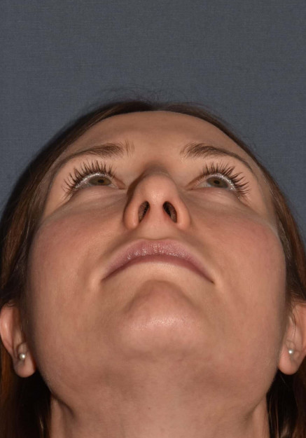 After Image: Rhinoplasty – Closed - other