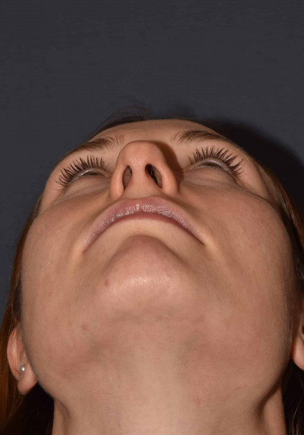Before Image: Rhinoplasty – Closed - other