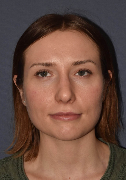 After Image: Rhinoplasty – Closed - front