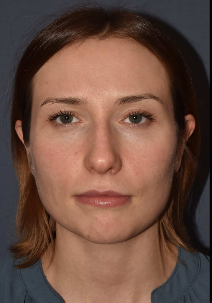 Before Image: Rhinoplasty – Closed - front