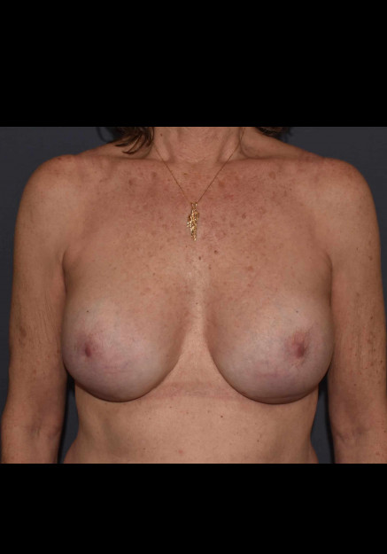 Breast Augmentation Revision