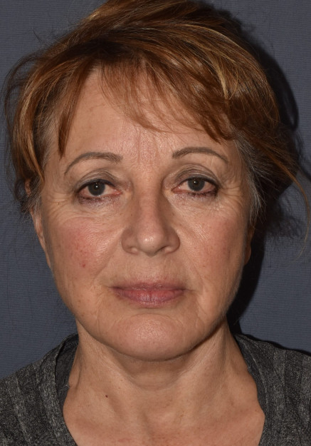 After Image: Facial Rejuvenation – Facelift with Chin Implant - front