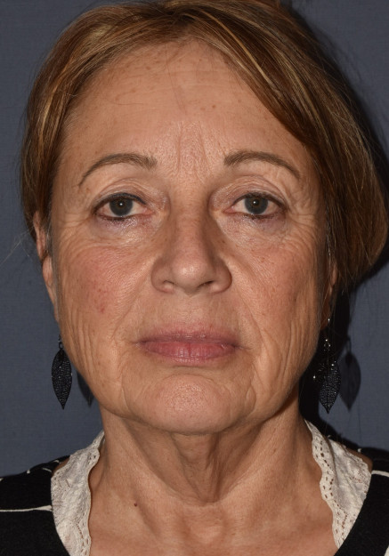 Before Image: Facial Rejuvenation – Facelift with Chin Implant - front