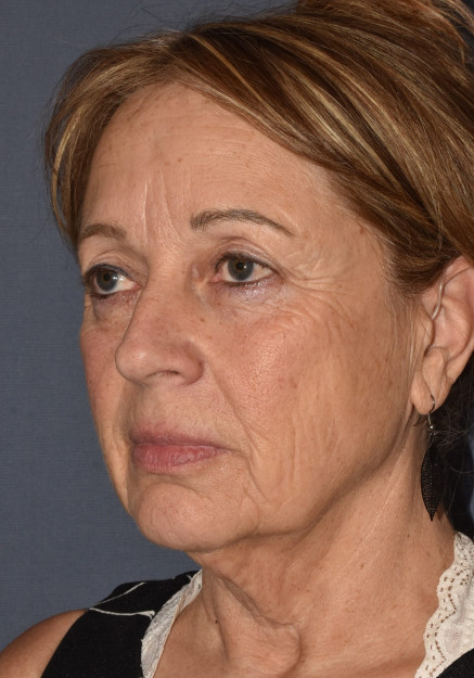 Facial Rejuvenation – Facelift with Chin Implant