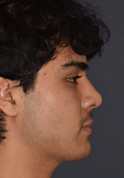 Rhinoplasty – Open