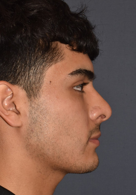 Rhinoplasty – Open