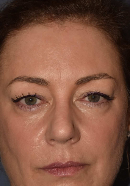 Facial Rejuvenation – Upper Blepharoplasty ( eyelid)
