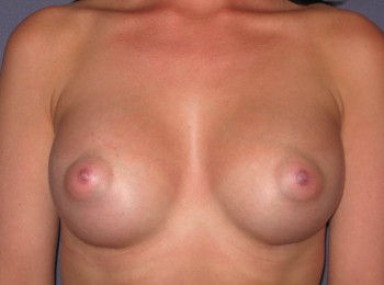 After Image: Breast Augmentation Before Pregnancy - front