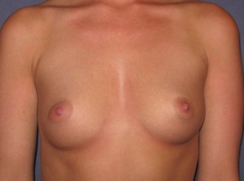 Before Image: Breast Augmentation Before Pregnancy - front