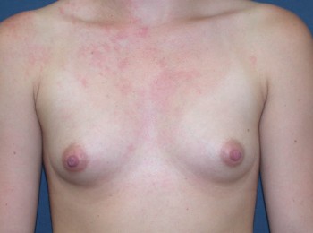 Before Image: Breast Augmentation Before Pregnancy - front