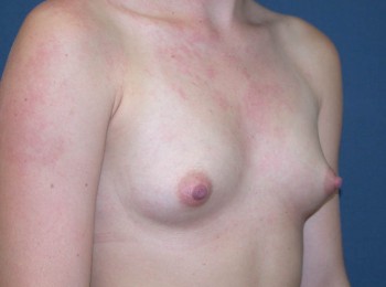Breast Augmentation Before Pregnancy