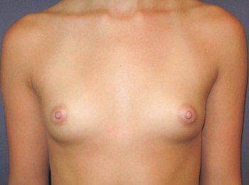 Before Image: Breast Augmentation Before Pregnancy - front
