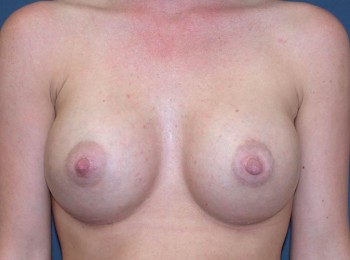 After Image: Breast Augmentation After Pregnancy Volume Loss - front
