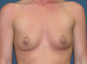 Before Image: Breast Augmentation After Pregnancy Volume Loss - front